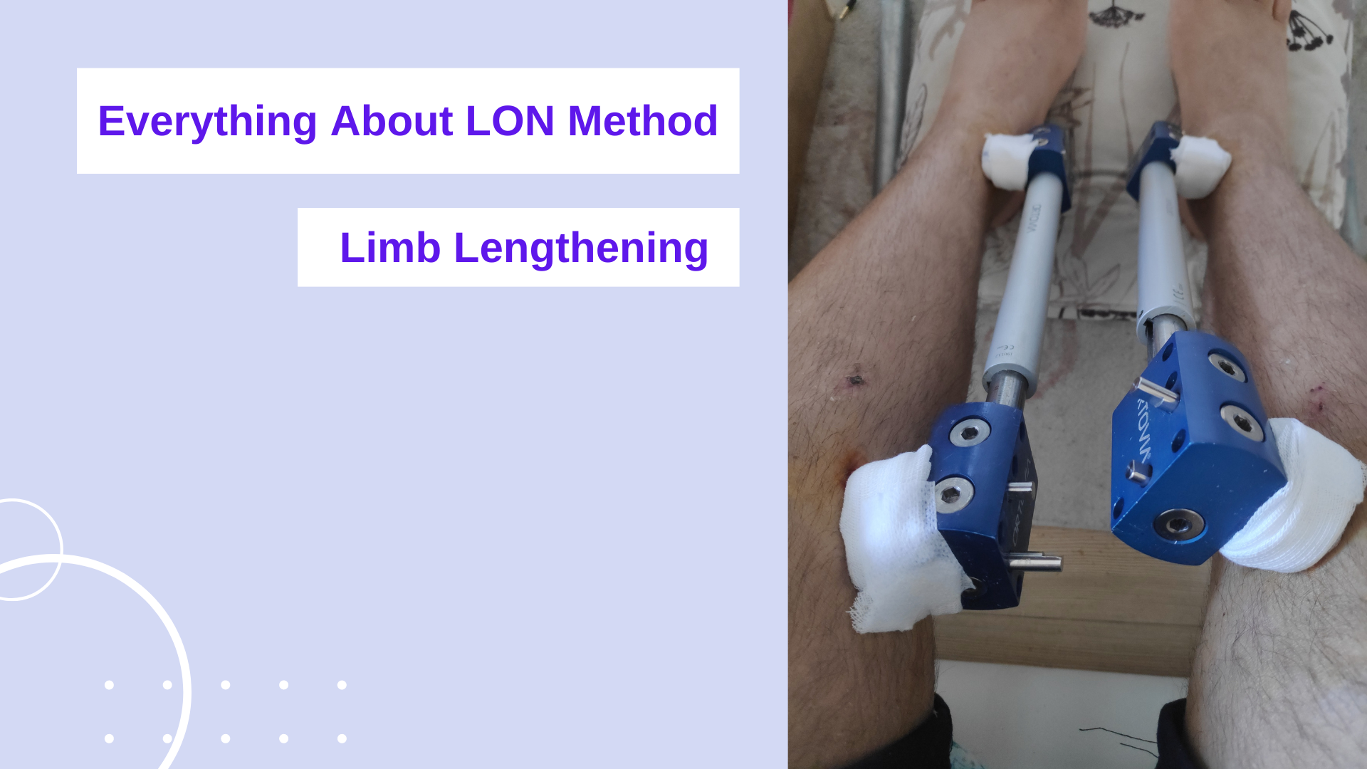 Everything About LON Method Limb Lengthening